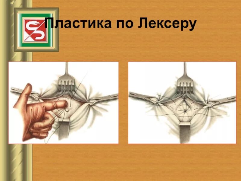 Пластика по другому. Пластика по другому. Лоскут кожи на питающей сосудистой ножке. Пластика паховой грыжи по жирару-спасокукоцкому. Пластика по мейо и сапежко.