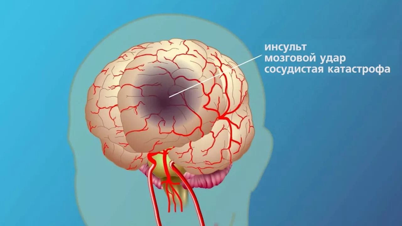 Инсульт картина. Головной мозг. Инсульт. Инсульт рисунок.