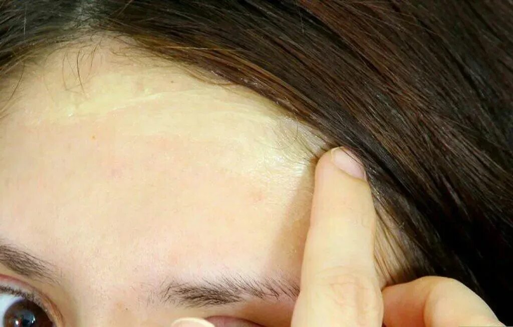 Линия роста волос на лб. Линия роста волос на лб. Линия роста волос у женщин. Линия роста волос на лб. Линия волос.