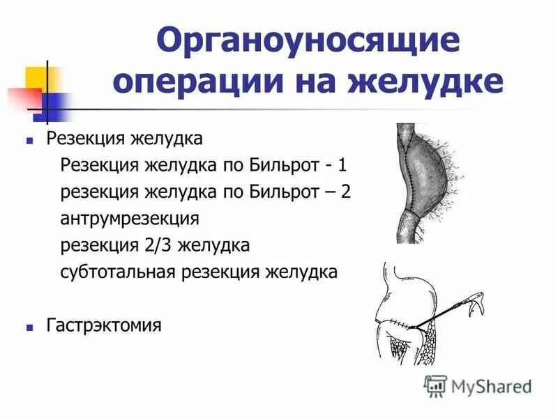 Умер от резекции желудка. Болезни оперированного желудка. Резекция желудка классификация. Классификация болезней оперированного желудка. Органососохраняющие операции на желудке.