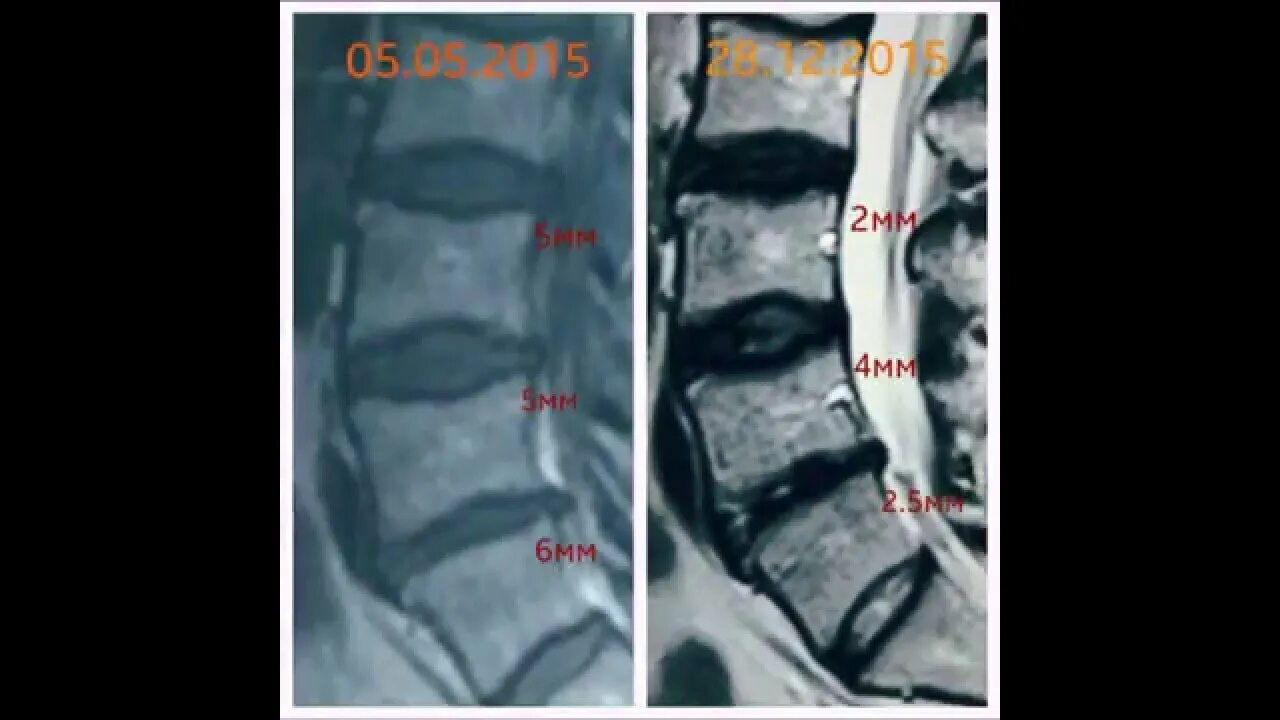 Межпозвонковая грыжа без операции. Лечение грыжи позвоночника без операции. Спинная грыжа без операции. Грыжа позвоночника на рентгене.