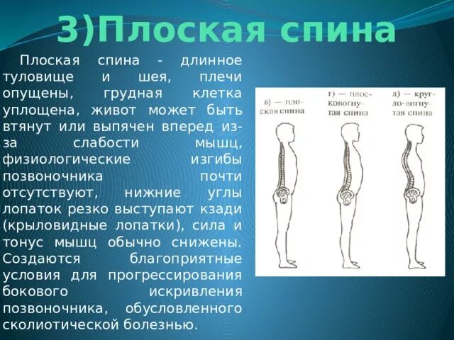 Спин удлинит. Плоская спина. Осанка плоская спина. Тип осанки плоская спина. Плоско вогнутая спина.