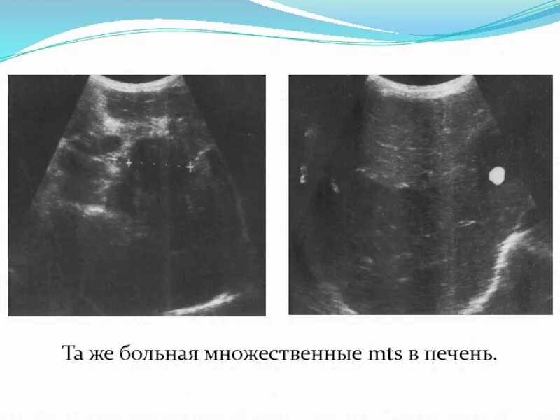 Множественные mts печени что это. Расшифровка детализации. Классификация опухолей по стадиям. Расшифровка детализации. Обозначения в детализации мтс.