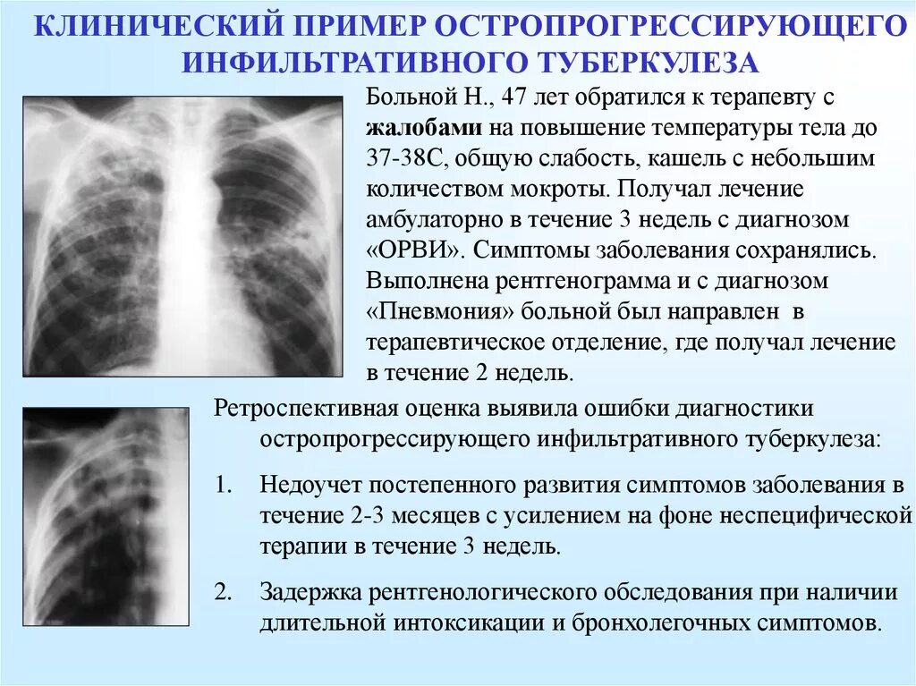 Диффузно инфильтративная. Клинические симптомы инфильтративного туберкулеза. Лобулярный инфильтративный туберкулез рентген. Инфильтративный туберкулез верхней доли рентген. Инфильтративная форма туберкулеза на рентгене легких.