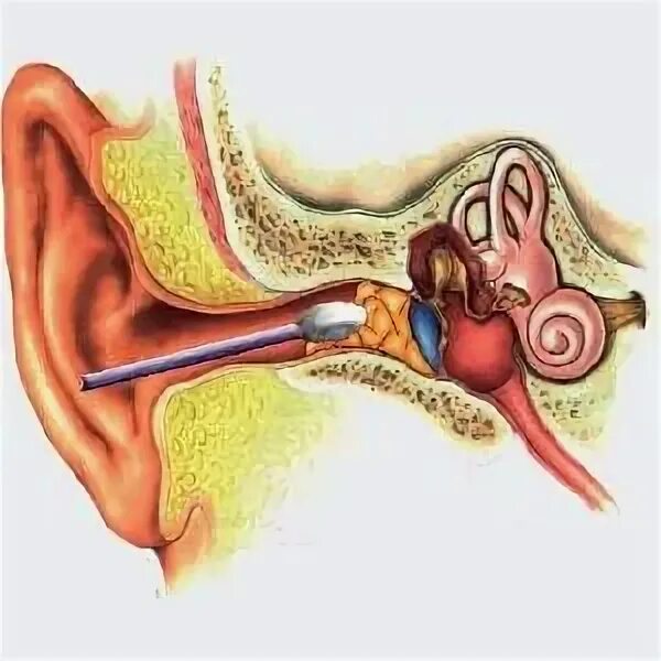 Заложило ухо ватной палочкой что делать. Перфорация барабанной перепонки ватной палочкой. Серная пробка на барабанной перепонке. Промывание слухового прохода.