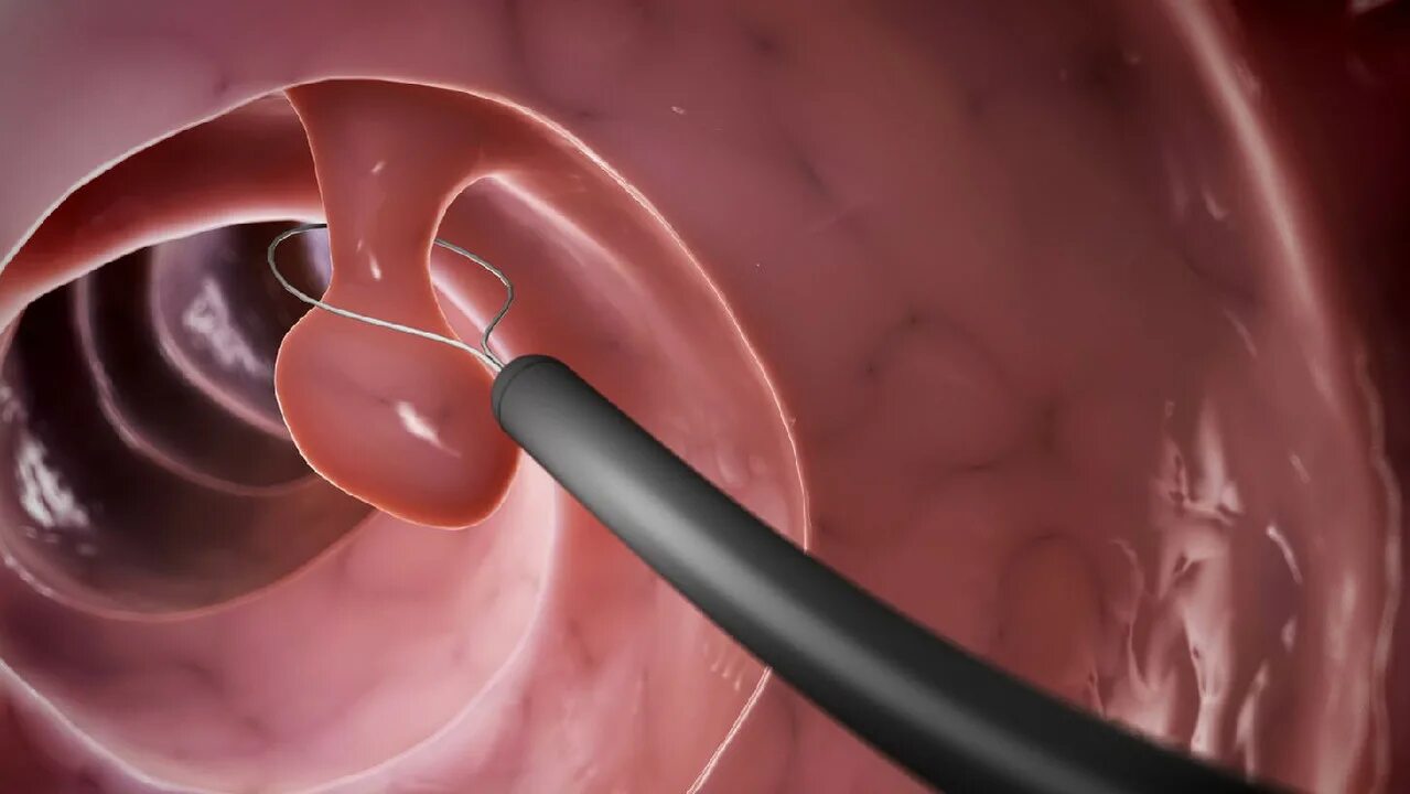 Эндометрия сосудов. Полипэктомия шейки матки. Эндоскопическая полипэктомия толстой кишки. Гистерорезектоскопия полипа. Полип цервикального канала.