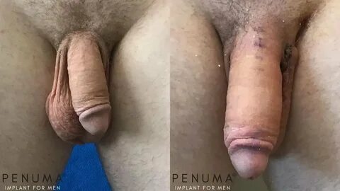 Penuma Before and After Penis Image Gallery