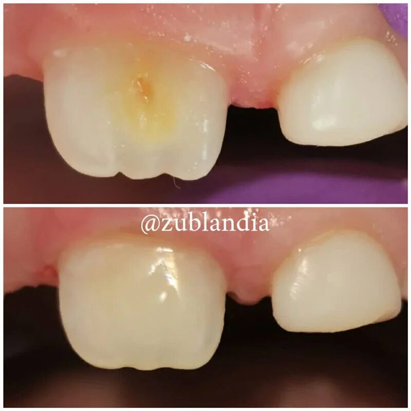 шкала вита а1 виниры. временный эмали. коричневая эмаль зубов. временный эмали. временный эмали.