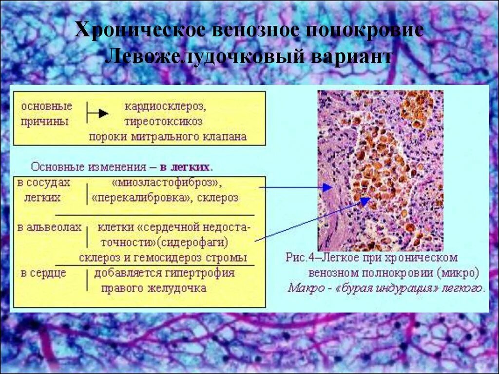 Печень при хроническом венозном застое. Клетки сердечных пороков. Хроническое венозное полнокровие процессы. Хроническое венозное полнокровие легких. Причины развития венозного полнокровия.