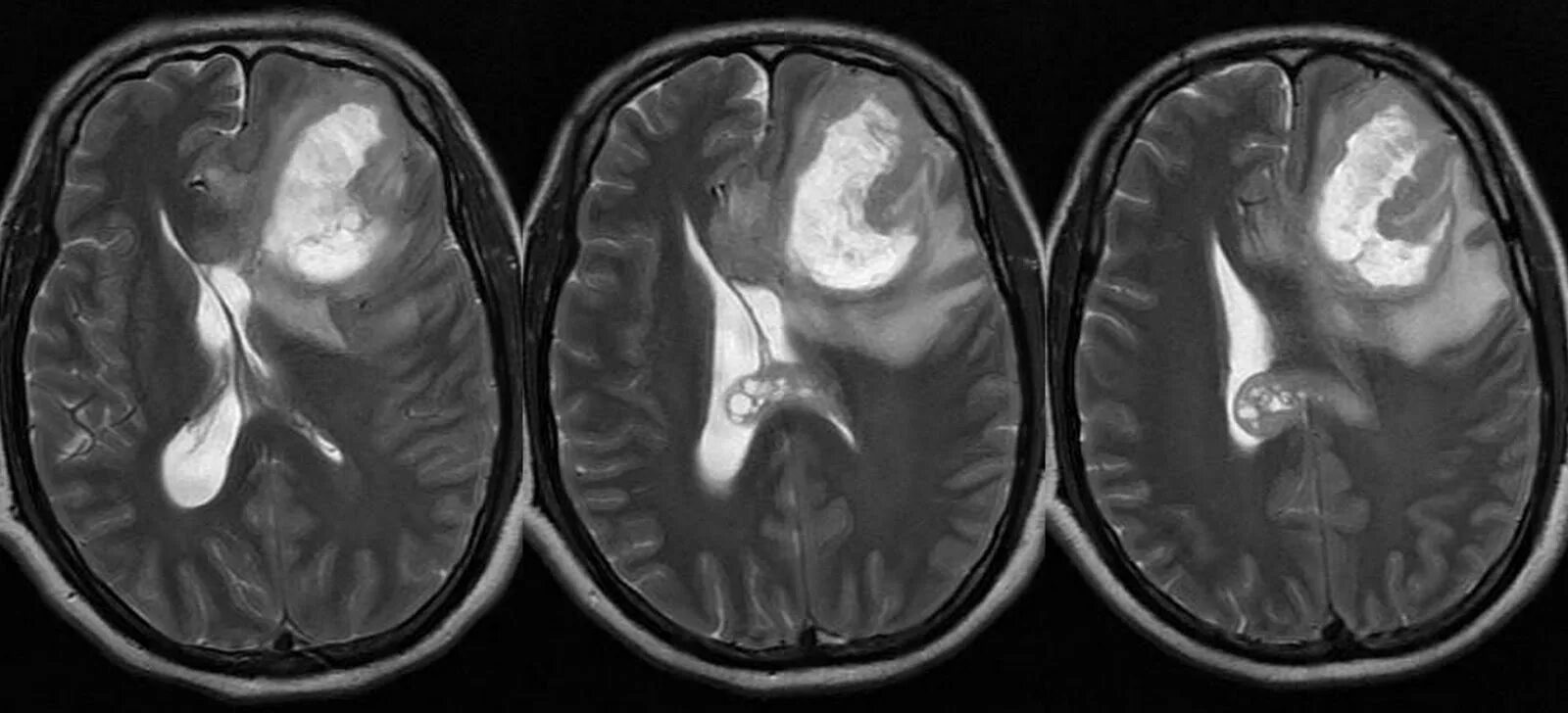 Опухоль мозга глиобластома. Мультиформная глиобластома мрт. Глиобластома 4 степени. Глиобластома на мрт мозга.