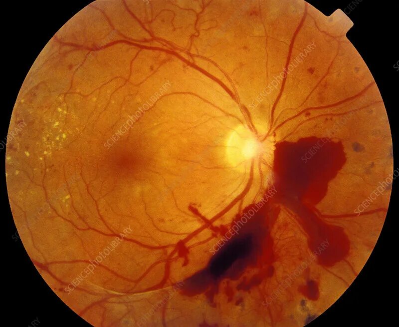 Заболевания сосудистой оболочки. Диабетическая ретинопатия сетчатки. Тракционная отслойка сетчатки. Кровоизлияние в сетчатку и стекловидное тело. Посттромботическая ретинопатия.