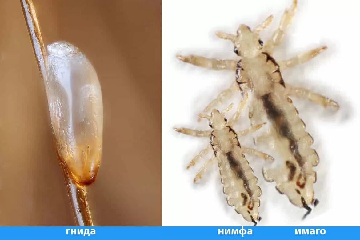 What Does Lice Look Like? Pictures of Nits, Eggs & Lice