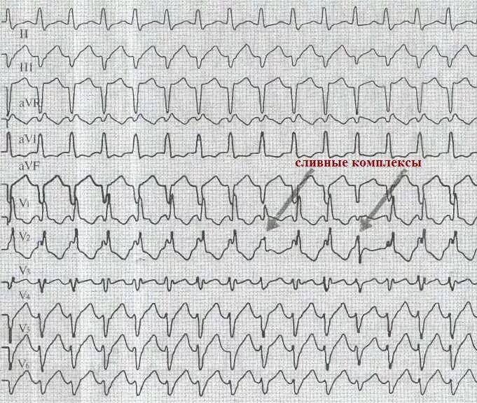 Тахикардия qrs. Тахикардия с широкими комплексами qrs. трепетание предсердий с широкими комплексами. желудочковая тахикардия с широкими комплексами на экг.