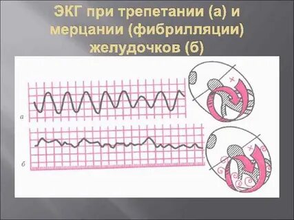 Фибрилляция желудочков экг