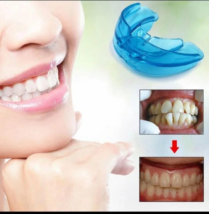 Можно ли кап. Бруксизм капа. Капа для выравнивания зубов. Ночная капа после брекетов. Можно ли кап.