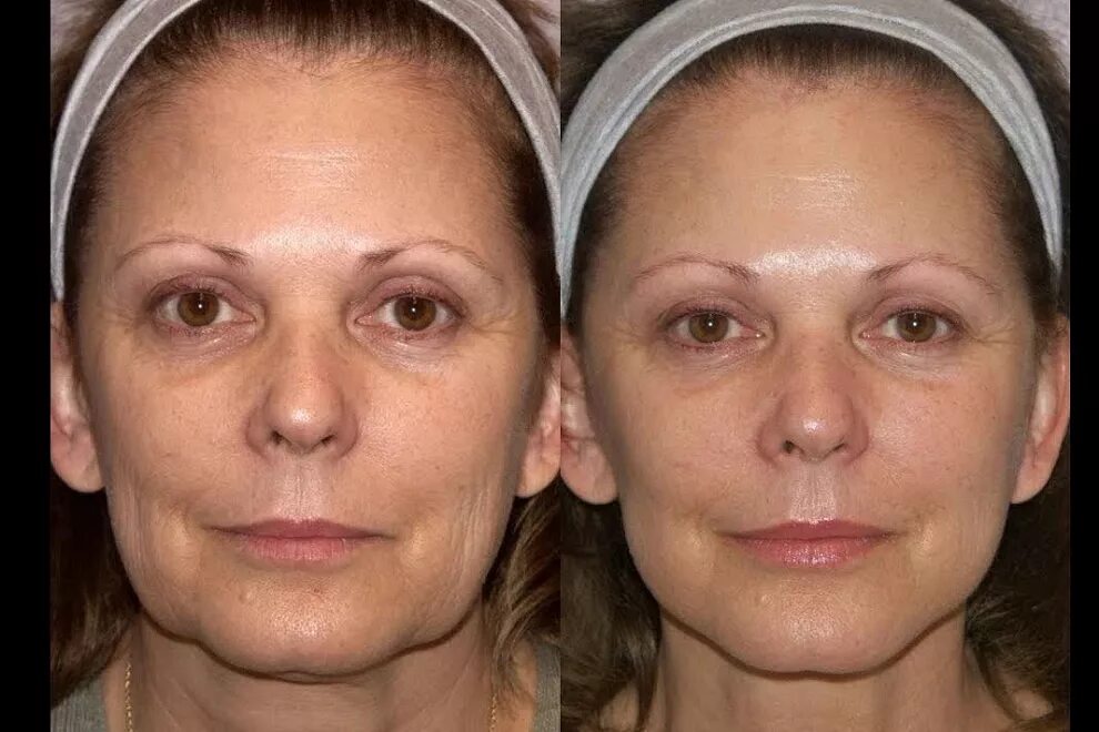 Нити аптос экселанс визаж. Radiesse векторный лифтинг до и после. Нитевой лифтинг аптос. Жидкие бионити. Подтяжка овала лица нитями.