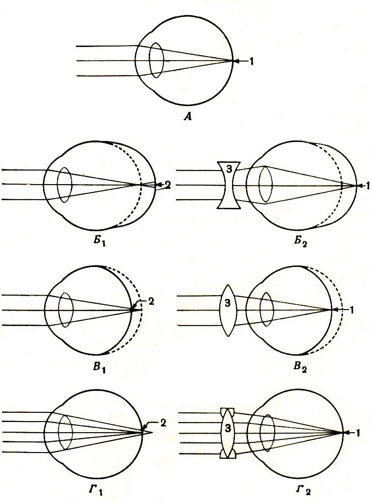 Нормальный глаз схема. Аномалии рефракции глаза близорукость дальнозоркость астигматизм. Аномалии рефракции: дальнозоркость, близорукость, астигматизм.. Астигматизм схема преломления лучей. Миопия дальнозоркость астигматизм.