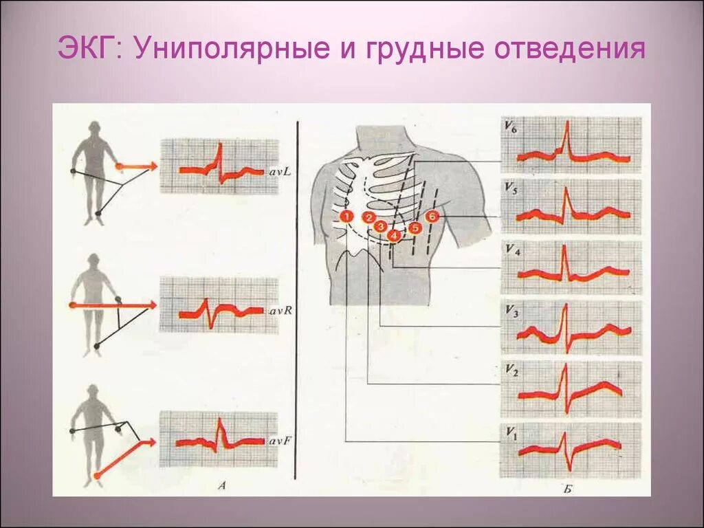 Грудные отведения на ЭКГ электроды. Грудные отведения ЭКГ норма. Отведения v1-v6 на ЭКГ. Грудные отвдеени янакг. Правые грудные отведения