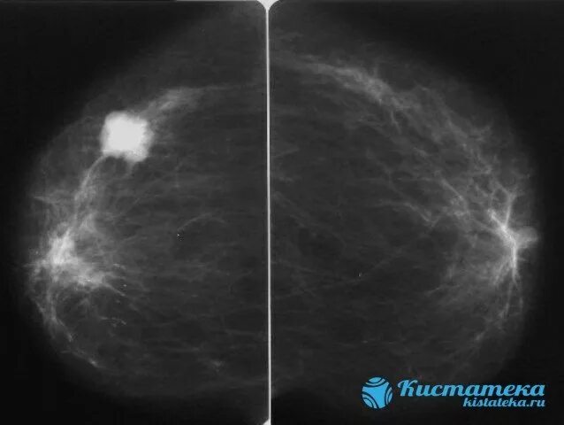 Округлые образования в молочной железе. Раковая опухоль маммография. Фиброзно-кистозная мастопатия снимок. Маммография опухоль молочной железы.