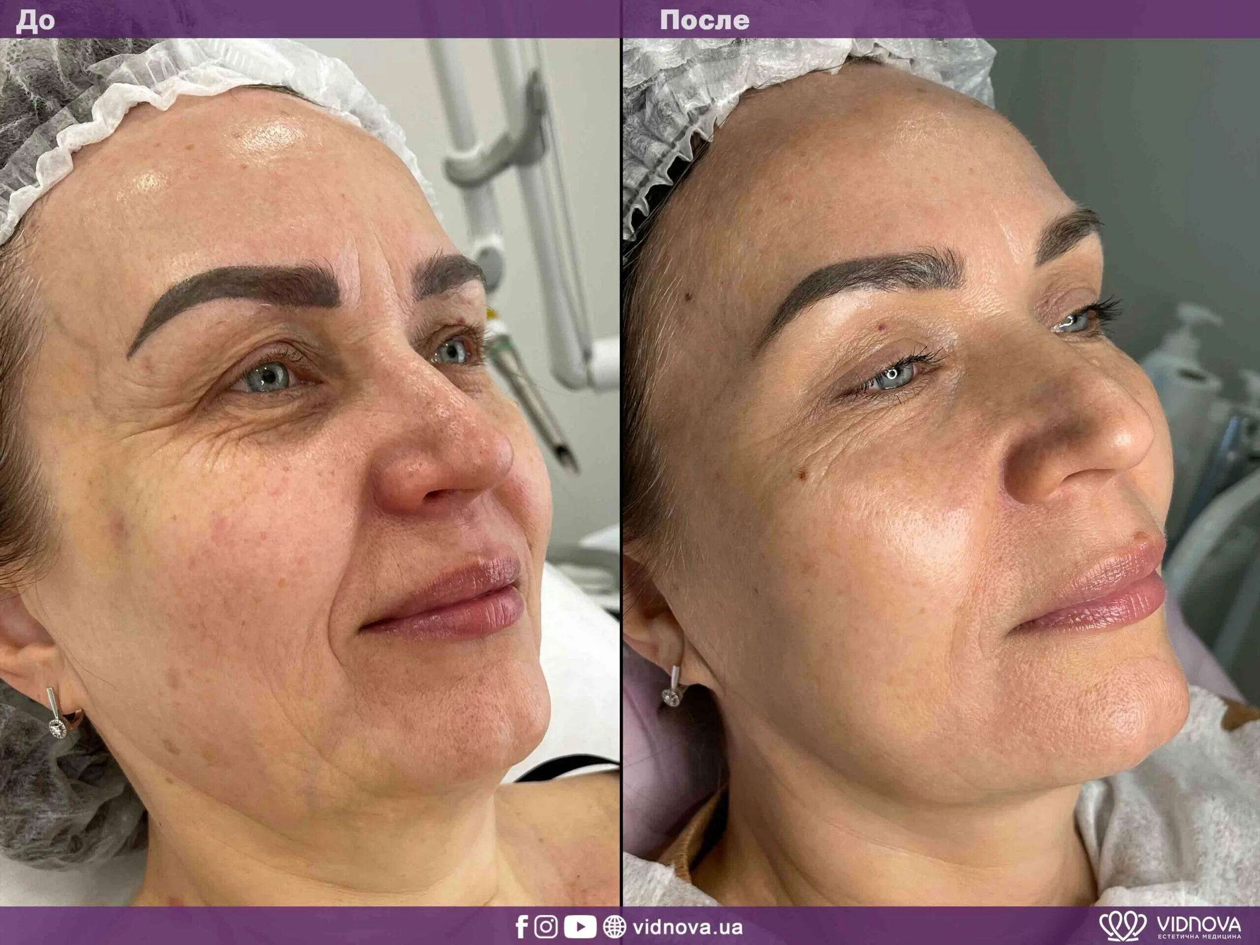 Фотоны 4 д омоложение. Фотоны 4 д омоложение. Омоложение на аппарате фотона 4д. Фотоны 4 д омоложение. Фотоны 4 д омоложение.