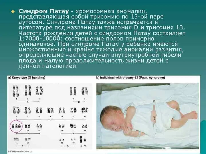 2 хромосома нарушения. Синдром Пата́у (трисомия 13). Транслокационная форма синдрома Патау. Синдром Патау — трисомия по 13 паре. Трисомии по 13 хромосоме (синдром Патау).