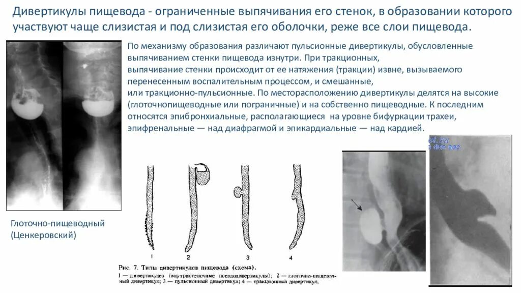 Локализация пищевода. Пульсионный дивертикул пищевода рентген. Тракционный дивертикул пищевода рентген. Заключение рентгена дивертикул пищевода.