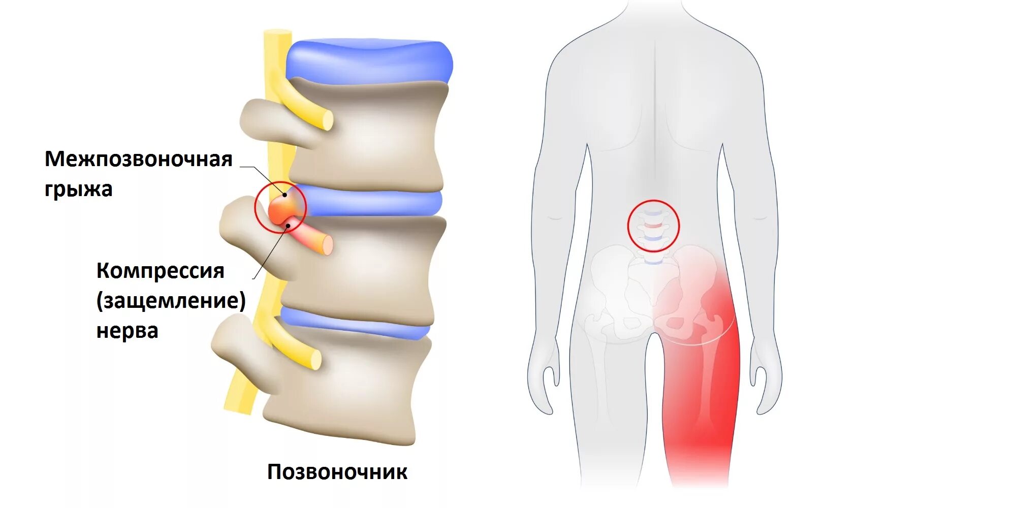 Защемление седалищного нерва грыжей позвоночника. Защемило нерв в пояснице. Зажало нерв в пояснице.