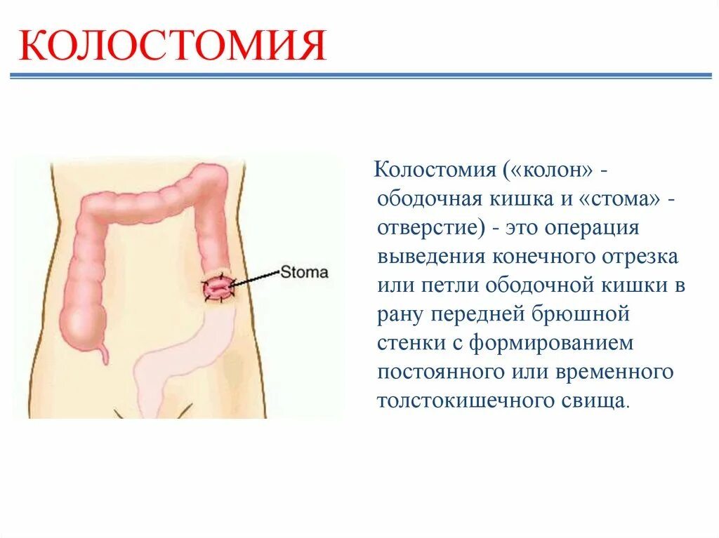 Операции через прямую кишку. Илеостома стомы Толстого кишечника. Резекция прямой кишки с наложением стомы. Колостома после операции прямой кишки.