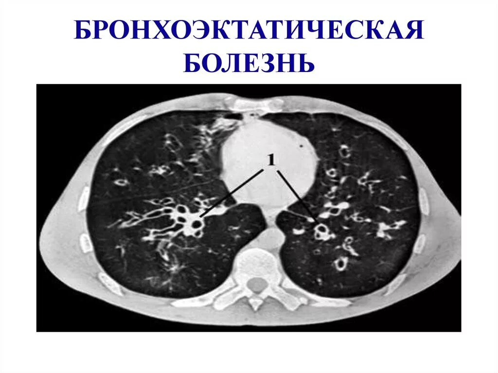 Бронхит бронхоэктатическая болезнь. Бронхоэктатическая болезнь кт. Бронхоэктазы на кт. Бронхоэктатическая болезнь фармакотерапия. J47 бронхоэктатическая болезнь.