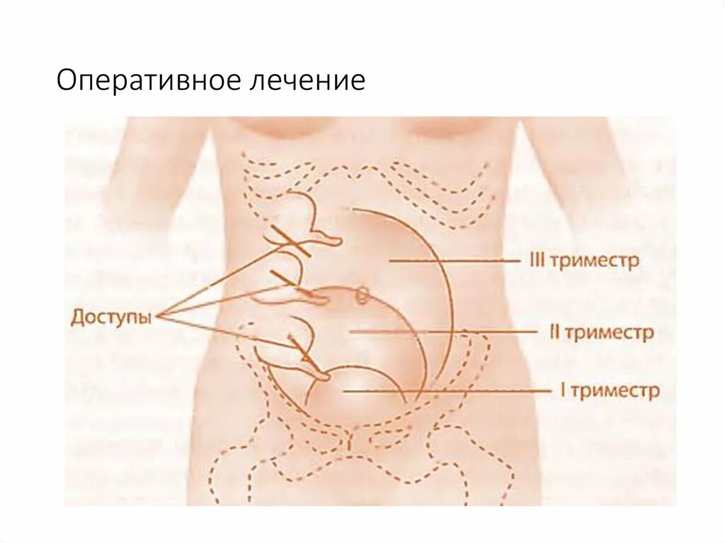 Где располагается беременность