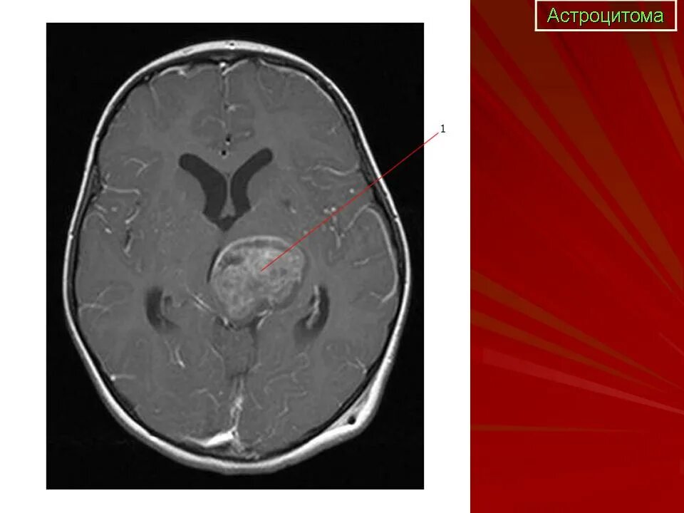 Пилоидная астроцитома. Анапластическая астроцитома гистология. Фибриллярная астроцитома гистология. Анапластическая астроцитома мозжечка кт. Фибриллярная астроцитома патанатомия.