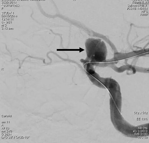 Аневризма сонной артерии что это. Супраклиноидный отдел ВСА аневризма. Мешотчатая аневризма ВСА. Эмболизация аневризмы микроспиралями. Эмболизация внутренней сонной артерии.