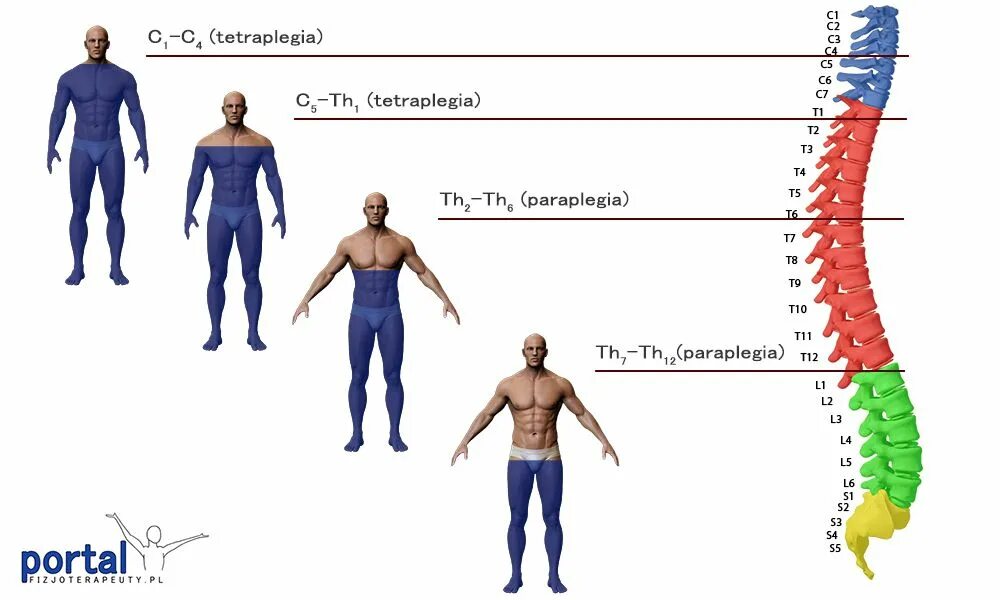 Как получить human. Нижний парапарез с уровня th10. Параплегия. Параплегия нижних конечностей. Параплегия верхних конечностей.