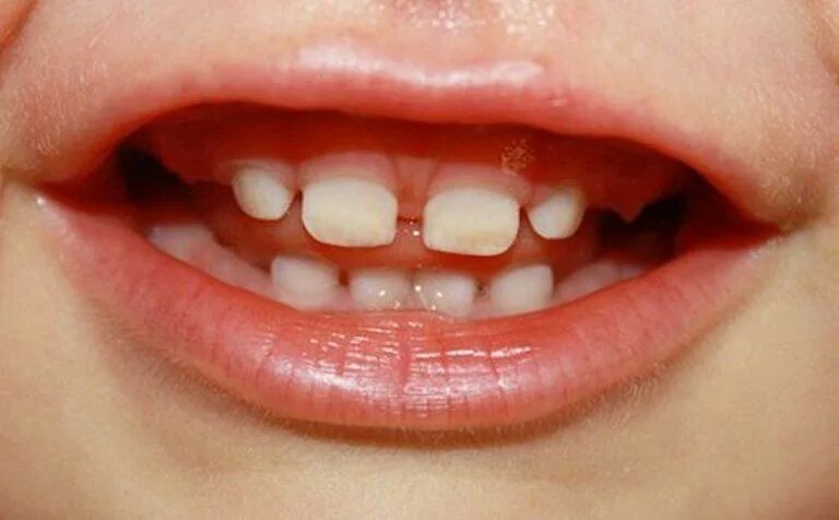 Ребенку 2 года 12 зубов. Гипоплазия эмали зубов. Гипоплазия эмали зубов у детей.