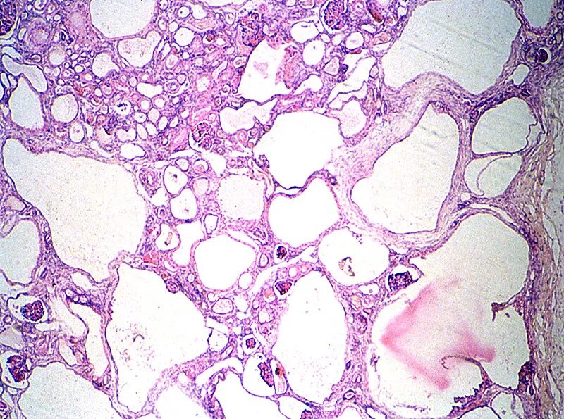 Кистозная дисплазия почки микропрепарат. Поликистоз почек микропрепарат. Поликистоз почек микропрепарат гистология. Поликистоз почек гистология. Пиелонефрит микропрепарат