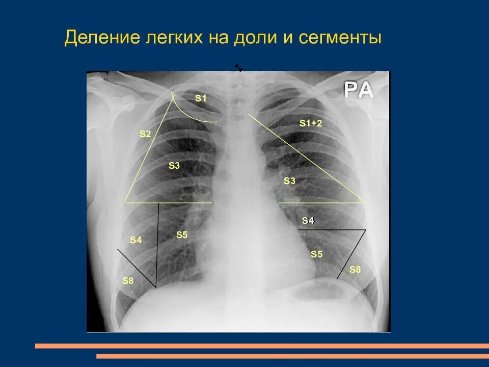 Три доли легкого. S4 s5 доли левого легкого. Сегменты легкого s1 s2. S10 сегмент левого легкого пневмония. S4 сегмент правого легкого кт.