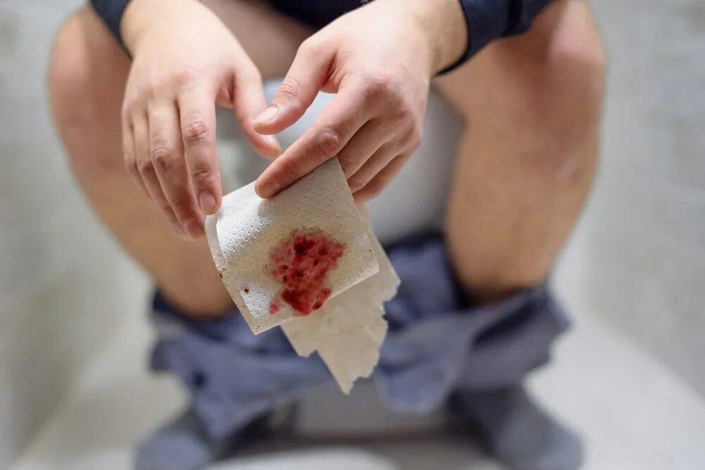 Геморрой: симптомы, диагностика и лечение в клинике Universum Clinic