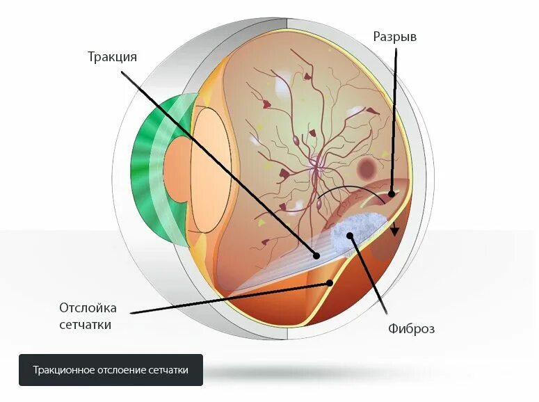 Диабетическая ретинопатия сетчатки глаза. Тракционная отслойка сетчатки глаза. Диабетическая ретинопатия отслойка сетчатки. Диабетическая ретинопатия глаз.