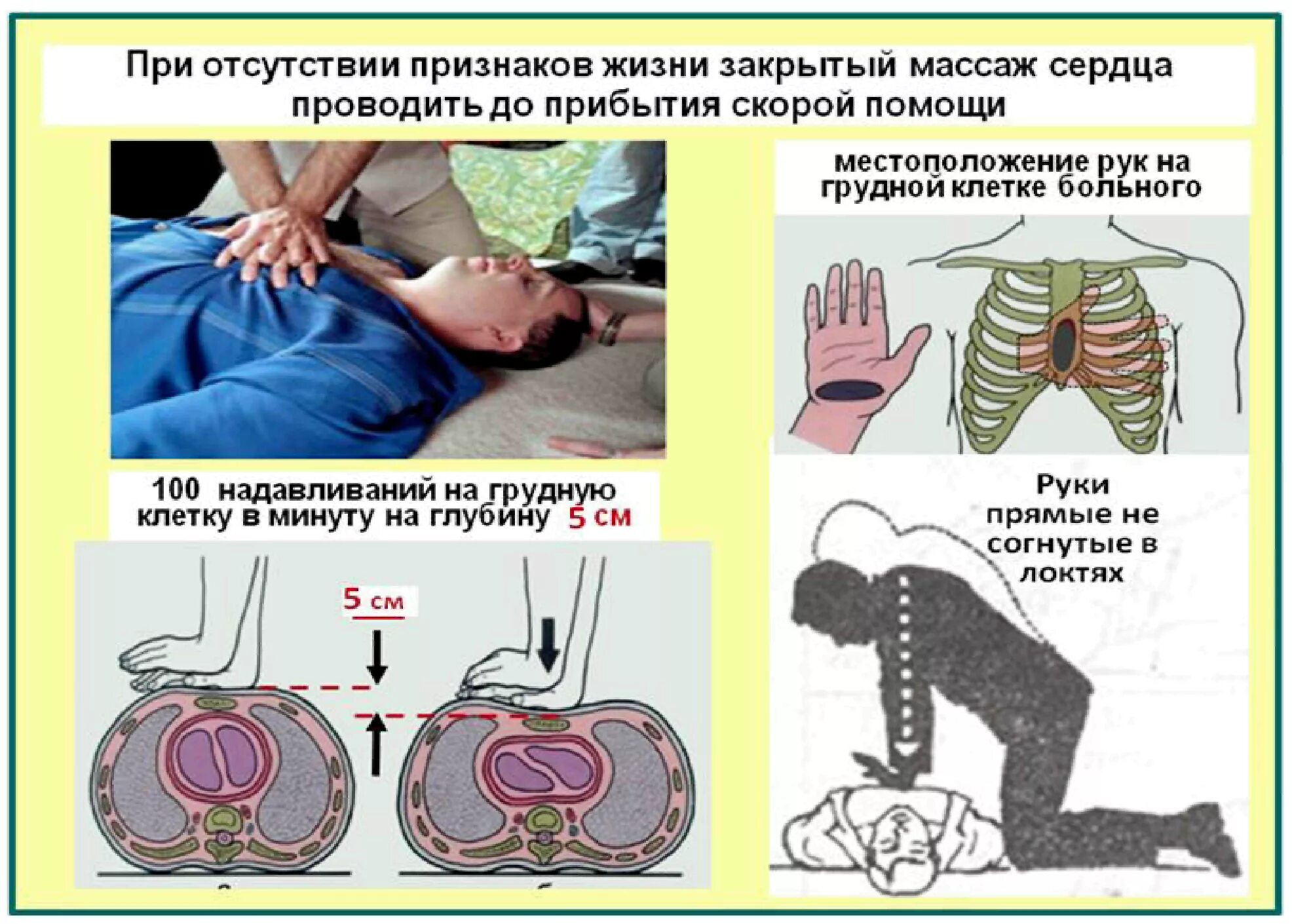 Алгоритм проведения наружного непрямого массажа сердца. Проведение наружного массажа сердца алгоритм. Схема проведения непрямого массажа сердца. Непрямой закрытый массаж сердца алгоритм. Как проводится непрямой массаж сердца