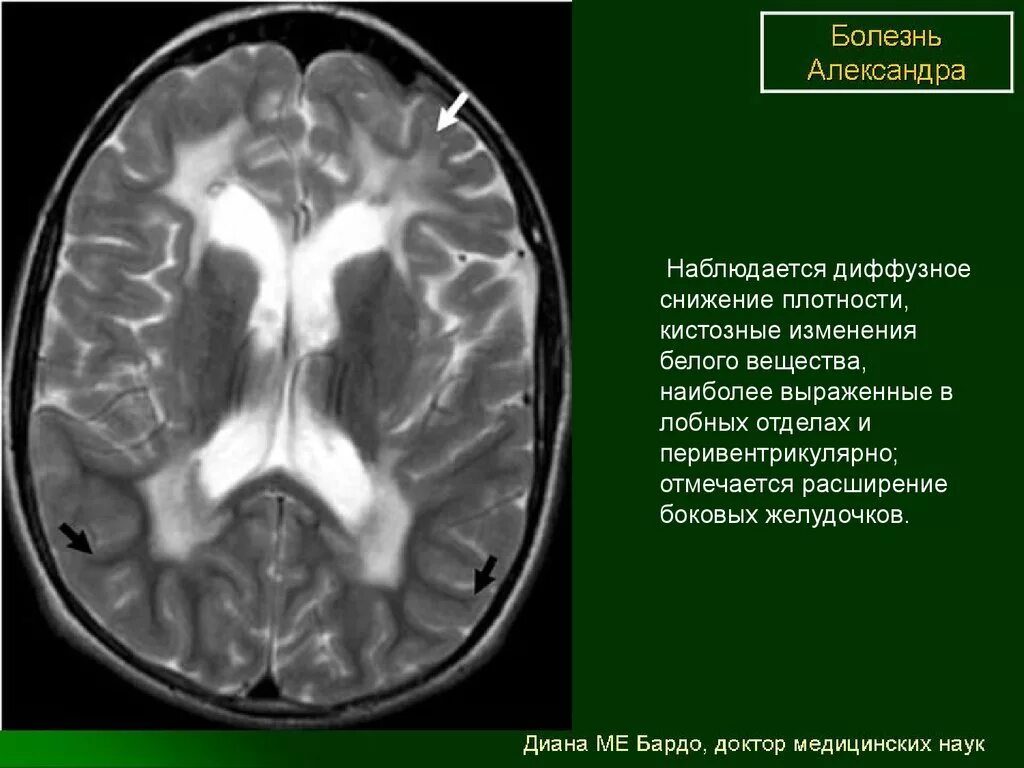 Диффузное снижение плотности. Лейкодистрофия Александера мрт. Лейкодистрофия головного мозга мрт. Лейкодистрофия Краббе.