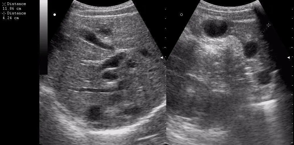 Паразитарная киста печени. Эхинококкоз печени УЗИ. Эхинококковая киста печени УЗИ. Эхинококкоз желчного пузыря.