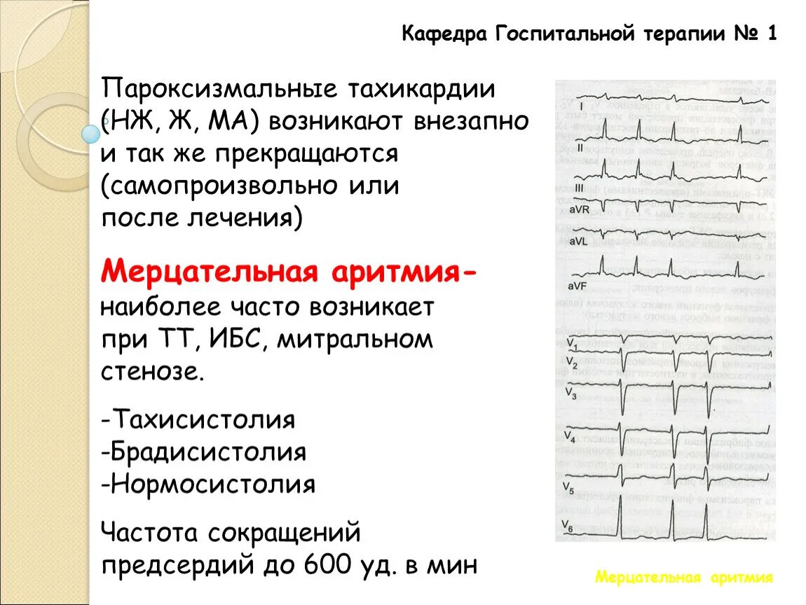 Тахисистолическая форма мерцательной аритмии. Мерцательная аритмия на ЭКГ. Синусовая тахисистолия ЭКГ. Мерцательная аритмия ЭКГ заключение.