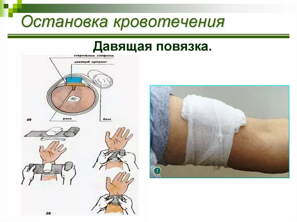 Давящая повязка при кровотечении время. Остановка кровотечения давящая повязка. Давящую повязку накладывают при кровотечении. Остановка кровотечения наложением давящей повязки. Наложение давящей повязки при кровотечении.