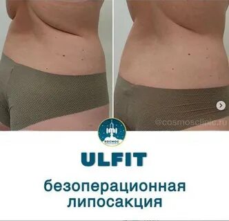 Откачать жир с живота
