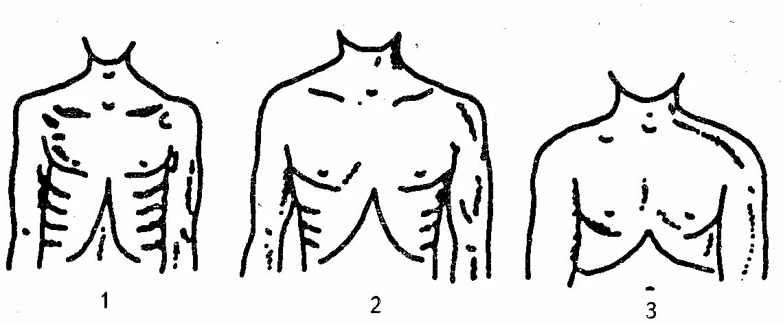 Форма грудной клетки и эпигастральный угол. Эпигастральный угол 90 градусов. Форма грудной клетки у астеников. Астеник угол грудной клетки. Грудная клетка у ребенка норма