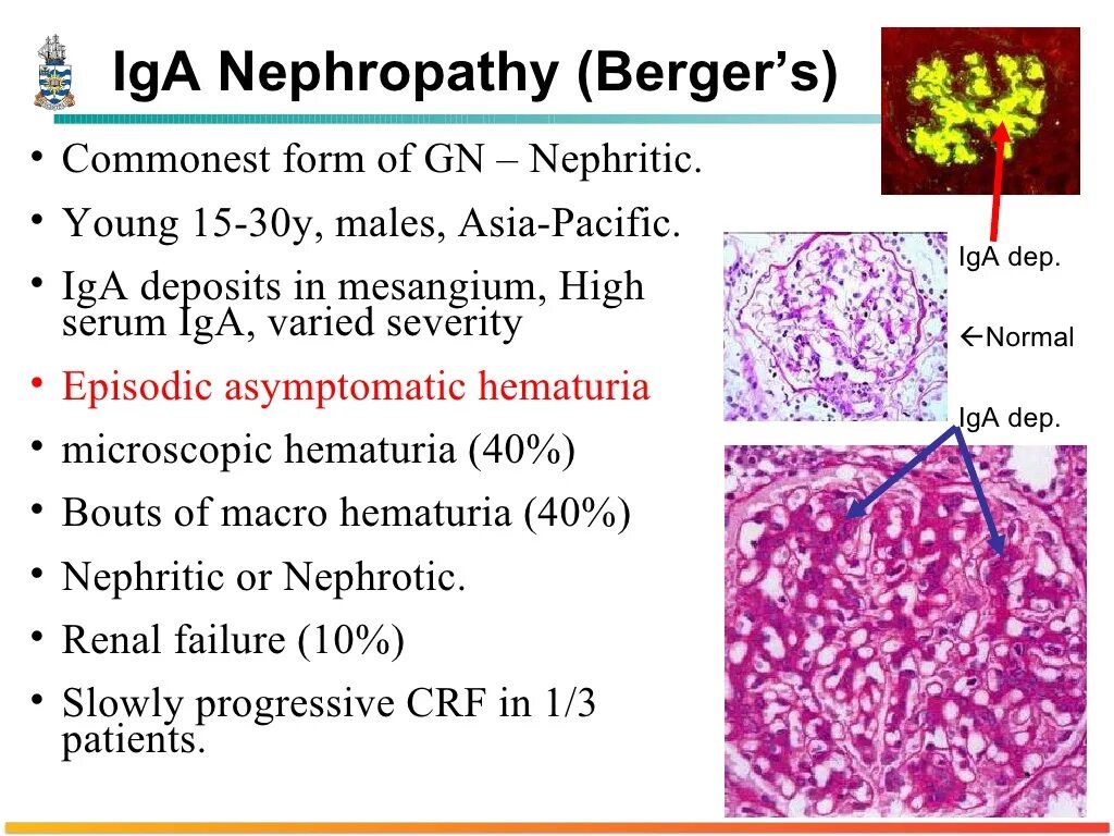 Common form. Iga нефропатия. Iga нефропатия патогенез. Iga нефропатия клинические рекомендации. Нефропатия iga микроскопия.