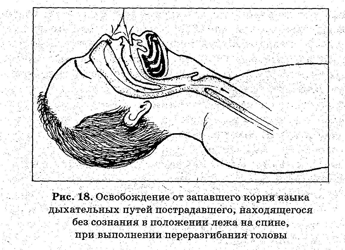 Западание языка помощь. При западении корня языка при проведении реанимации голова. для предупреждения западения корня языка. способы устранения западения языка.