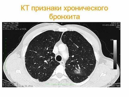 Кт легких видное