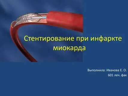 Стент после инфаркта