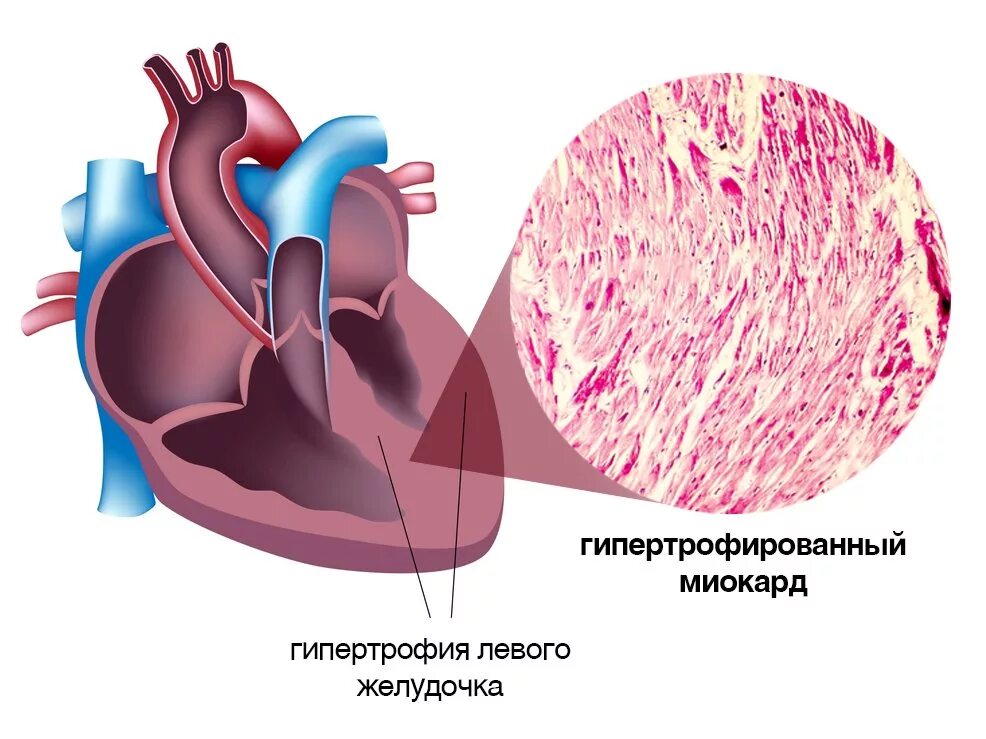Гипертрофия миокарда желудочков. Гипертрофия миокарда левого желудочка. Миокард левого желудочка. Миокард левого предсердия